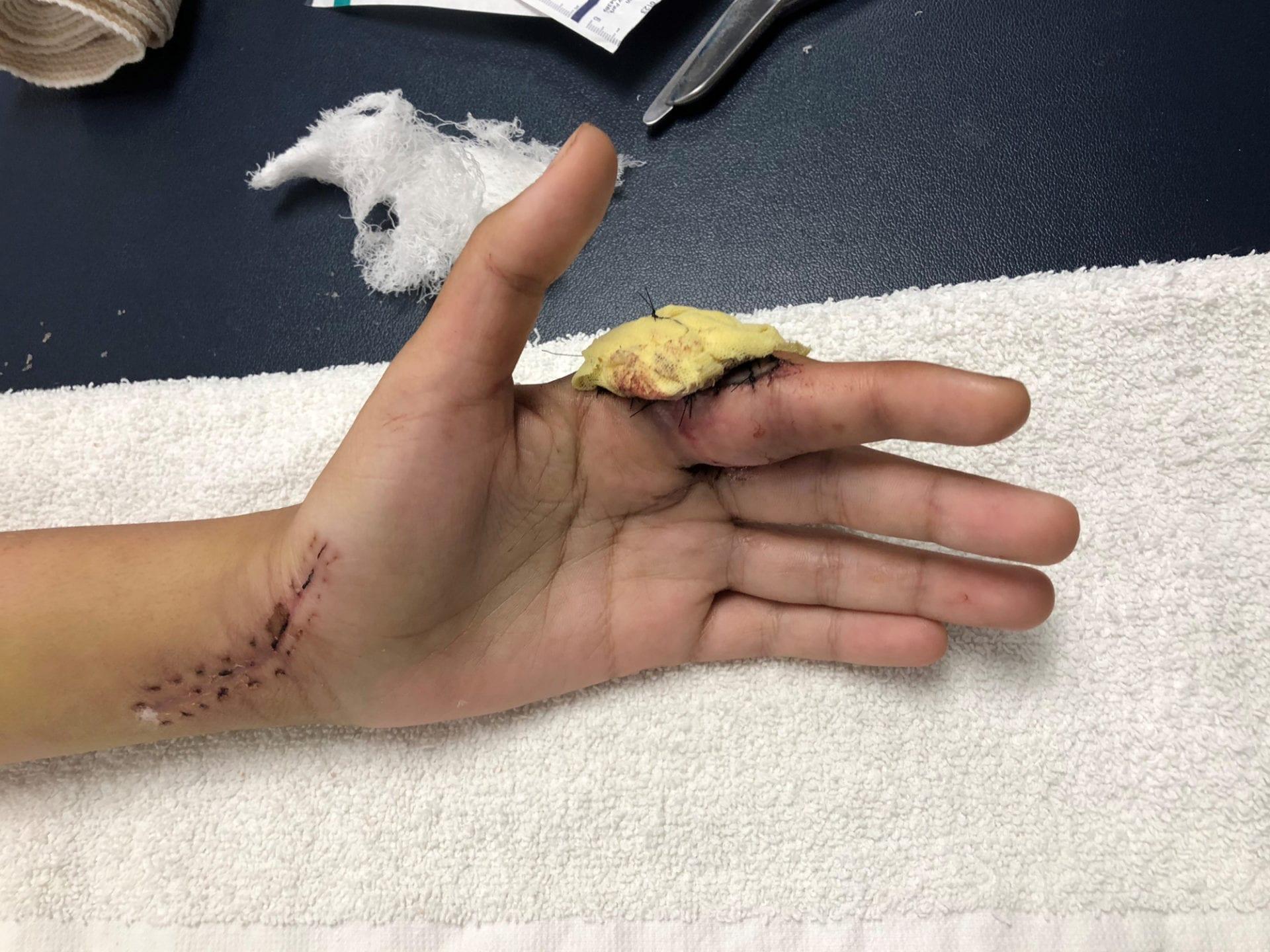 Precision Rehab, Occupational, Physical   Hand Therapy, P.L.L.C. | Tendon Repairs, Massage Therapy and Osteoporosis