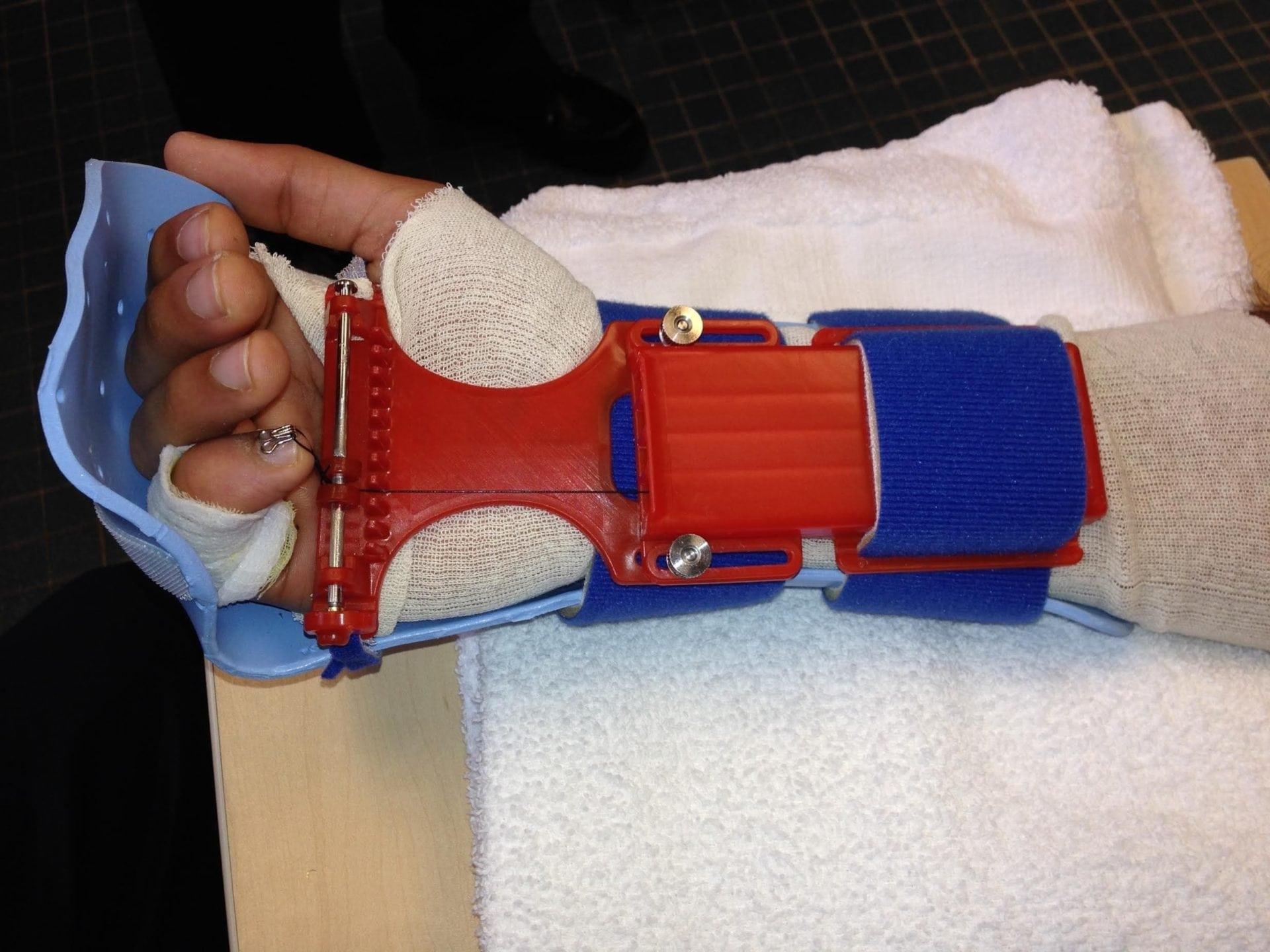 Precision Rehab, Occupational, Physical & Hand Therapy, P.L.L.C. | Fractures, Osteoporosis and TMJ