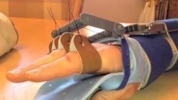 Precision Rehab, Occupational, Physical   Hand Therapy, P.L.L.C. | Osteoporosis, Fibromyalgia and Strength Training