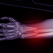 Precision Rehab, Occupational, Physical   Hand Therapy, P.L.L.C. | Hip Pain, Neurological Conditions and Fibromyalgia